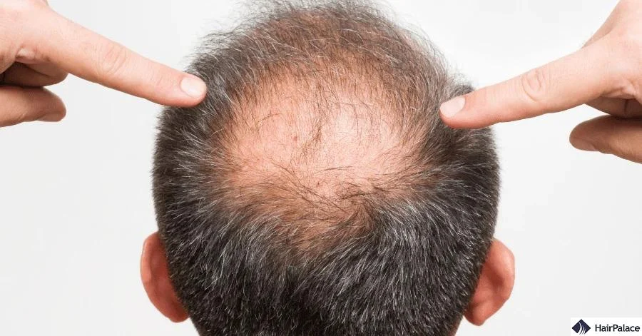 What Is DHT and How Does It Cause Hair Loss?