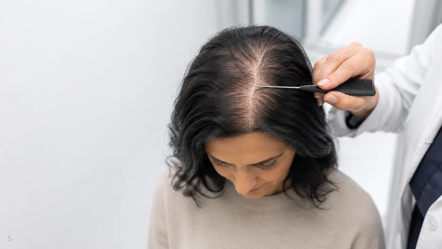 Ludwig Scale for Female Pattern Hair Loss: Stages, Symptoms, and Treatment Options