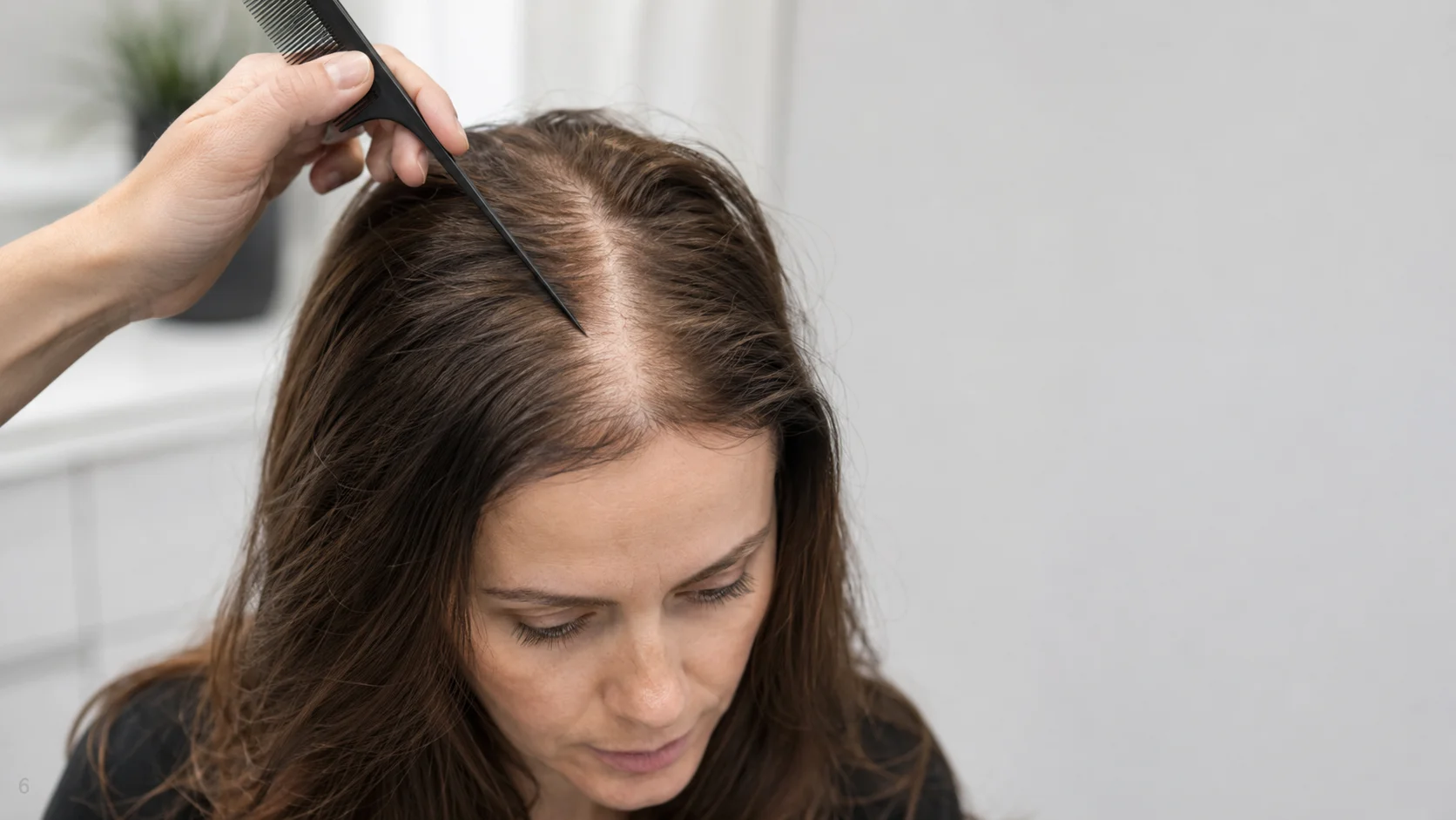 Olsen Christmas Tree Pattern Hair Loss: Causes, Signs, Diagnosis, and Treatment Options