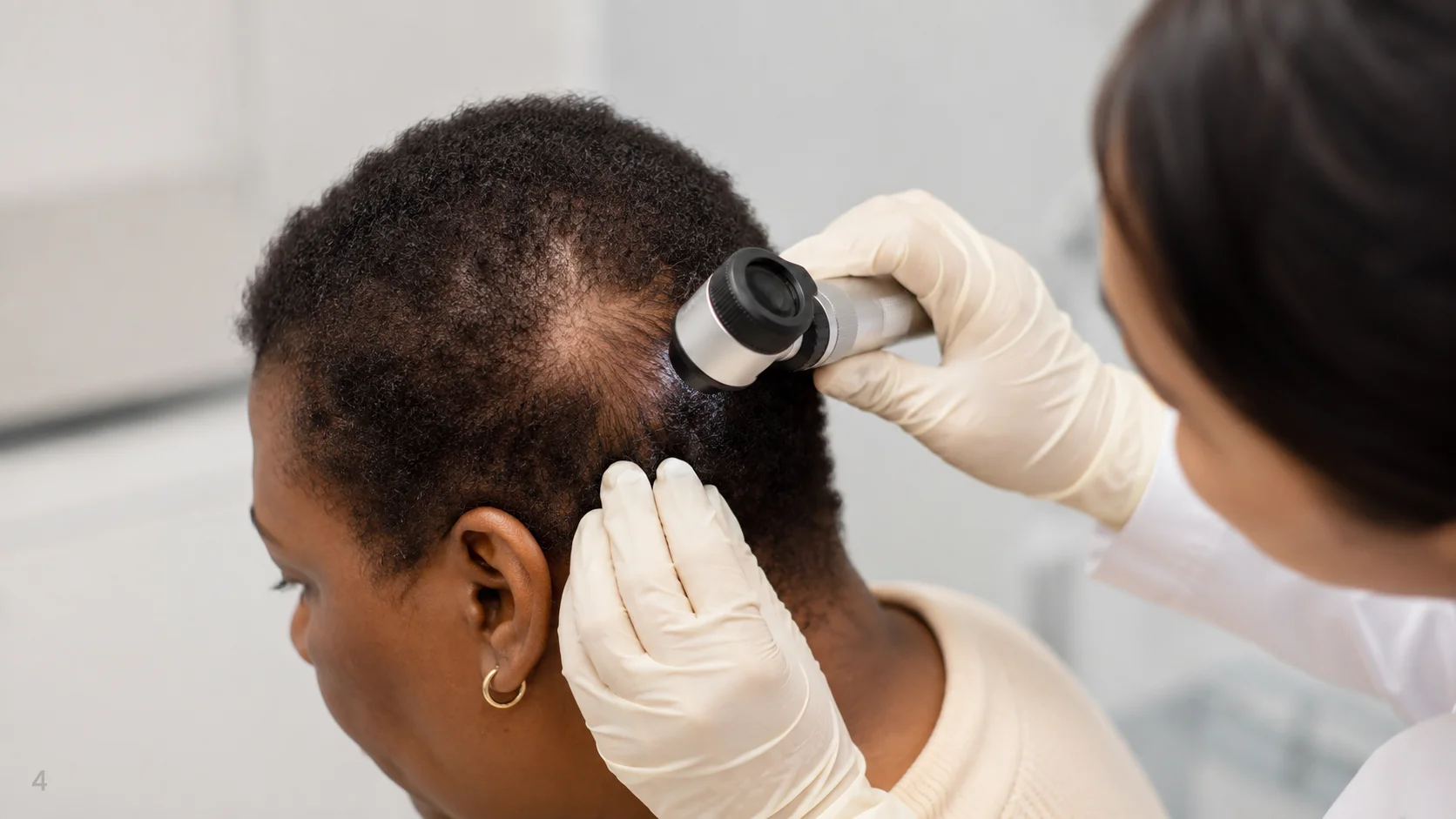 Chronic Cutaneous Lupus Erythematosus and Hair Loss: Causes, Symptoms, and Scarring Alopecia