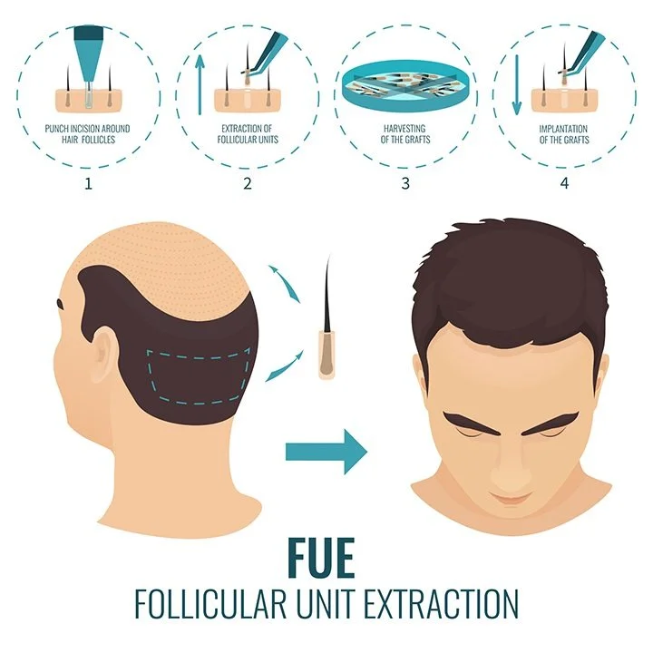 What Is FUE Hair Transplant? Benefits, Procedure, and How It Compares to DHI, Sapphire FUE, and Choi Pen